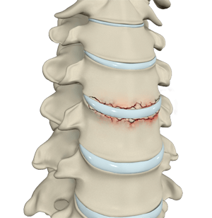 Cervical Fracture