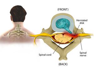 Cervical Radiculopathy