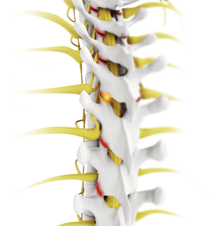 Facet Joint Arthritis