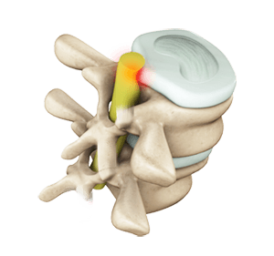 Lumbar Radiculopathy