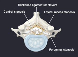 Spinal Stenosis