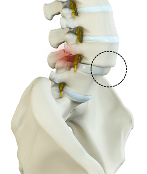 Spondylolisthesis