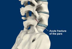 Spondylolysis