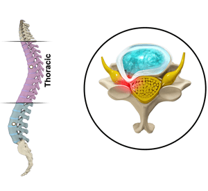 Thoracic Myelopathy